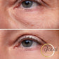 Antes y después del tratamiento  reductor de bolsas y ojeras  alrededor de los ojos.