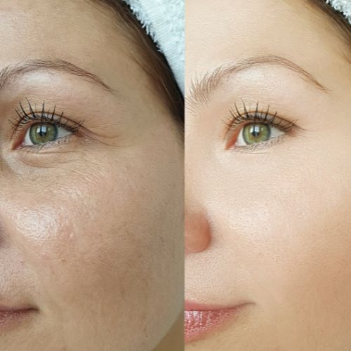 Before and after Synery Delete Serum