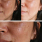 Woman dark spot face before and after