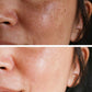 Woman dark spot face before and after