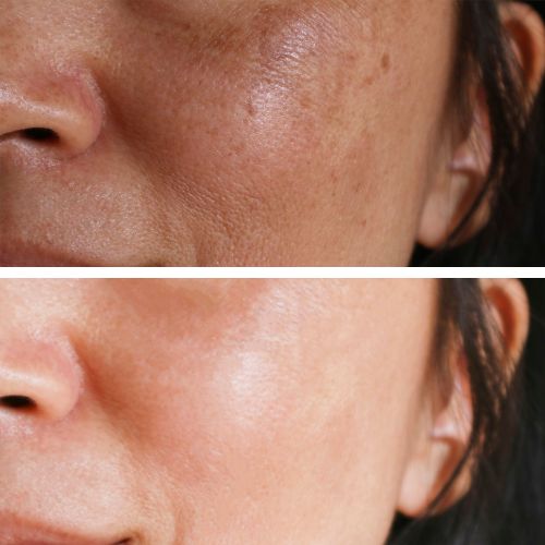 Woman dark spot face before and after